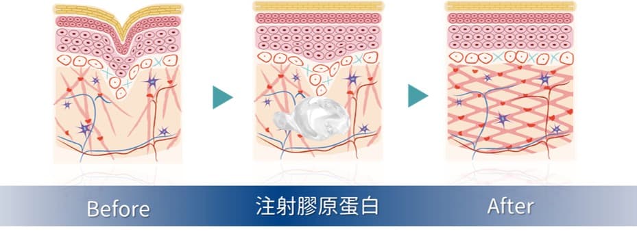 Sunmax 雙美膠原蛋白針 Before After 對比圖