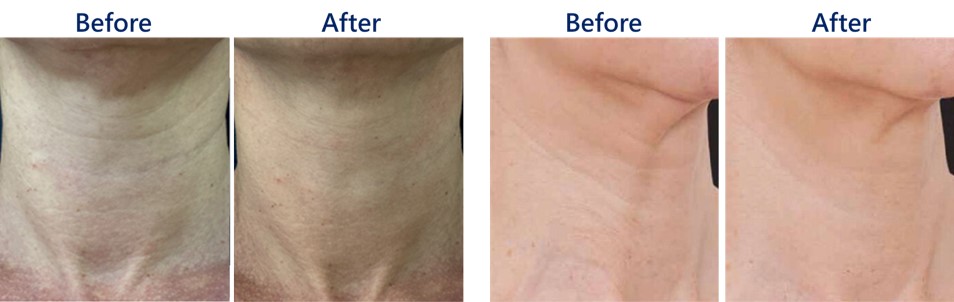 改善脖紋前後對照圖1