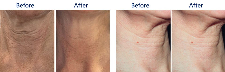 改善脖紋前後對照圖2