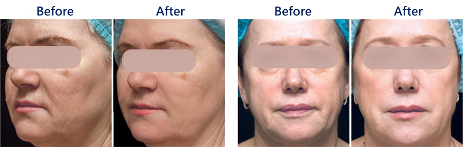 淡化脖紋前後對照圖