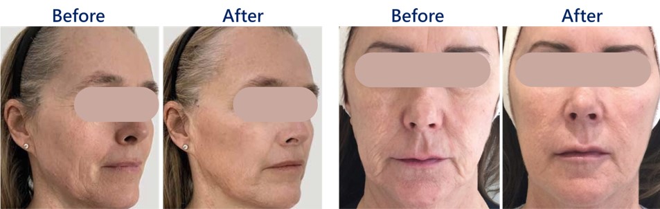 緊緻拉提對照圖